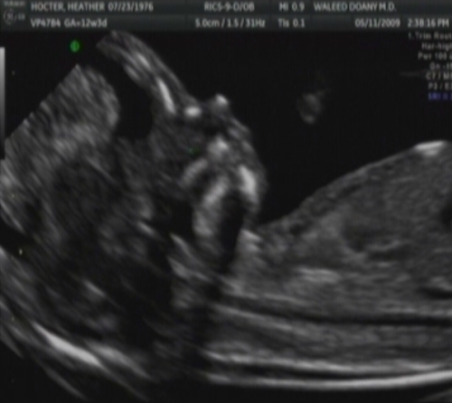 Baby Hocter at 14 Weeks